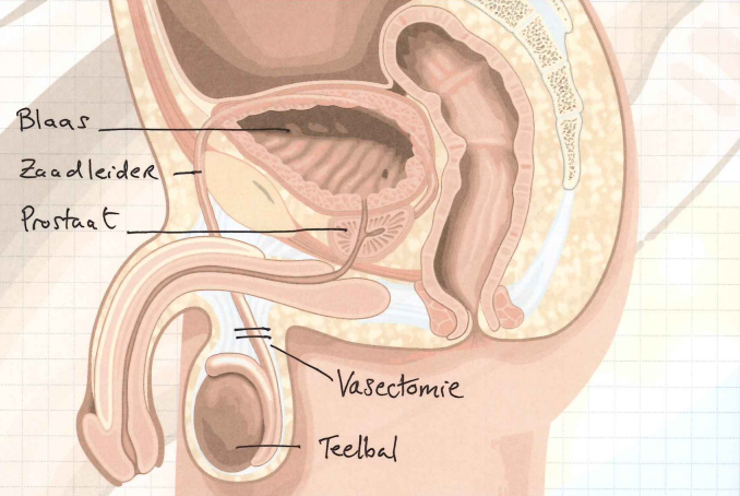 Vasectomie